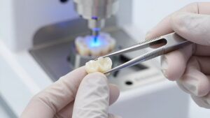Профессиональный захват керамической коронки пинцетом в рамках цифрового протокола установки коронок из циркония